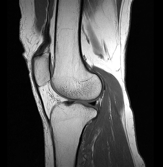 MRI Knee Sagittal Scan (AI Enhanced)